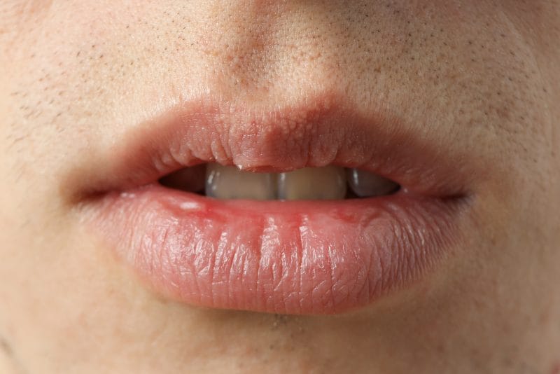 close up image of mouth with very dry lips